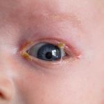 Close-up of a baby's eye with a yellow spot, possibly indicating yellow discharge, a sign of infection.