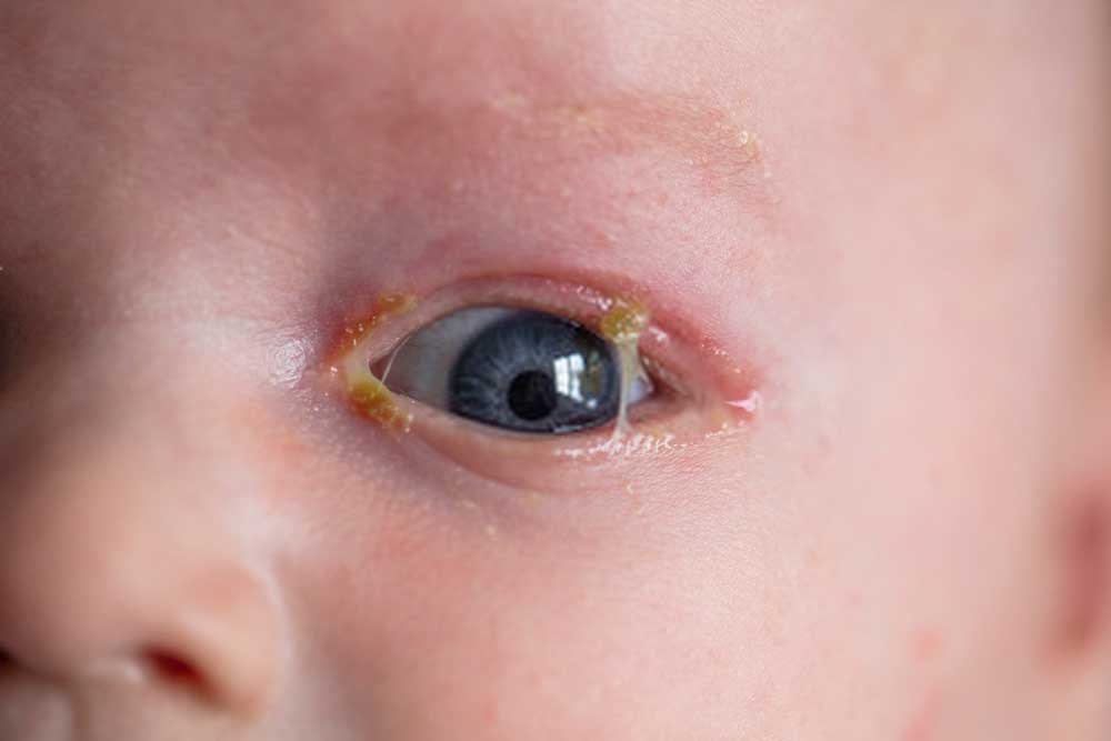 What Does Yellow Discharge from a Baby's Eye Indicate? - illustrated Tea Cup