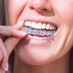 5 Reasons Why Invisible Braces Are Trending in Orthodontic Treatment