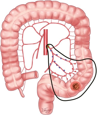 Colorectal Cancer Surgery Types